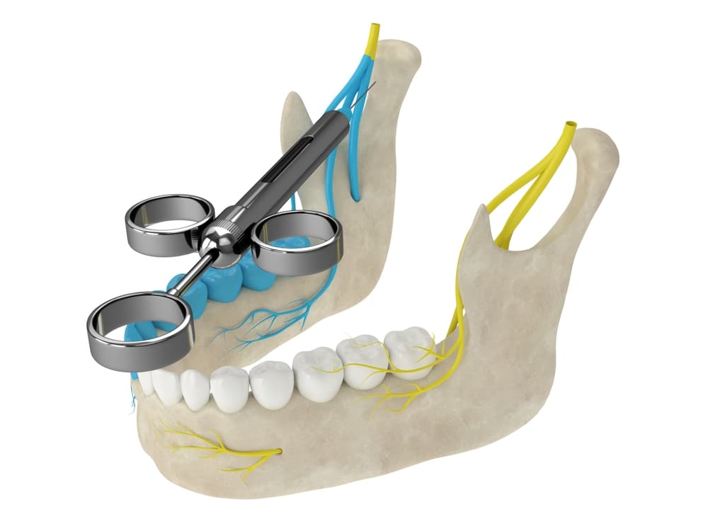 Evidence to Support a Dental Malpractice Claim Involving Nerve Damage